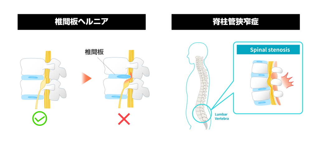 腰部椎間板ヘルニアと脊柱管狭窄症のイメージ図