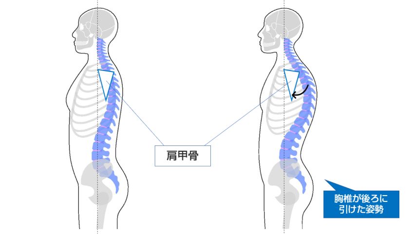 胸椎のバランスの違いによる肩甲骨の位置の相対的な位置の違いのイラスト