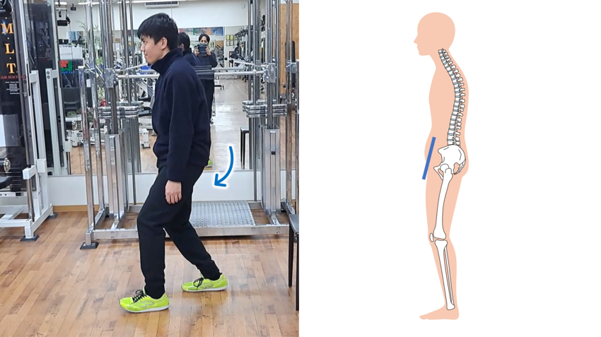 骨盤が後傾した状態で歩く男性とその際の骨盤のイラスト