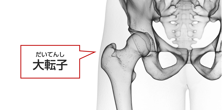 大腿骨大転子の位置を示す画僧