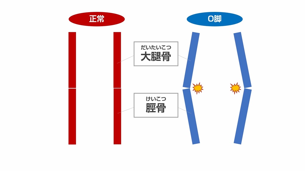 O脚でひざの内側にストレスがかかるイメージ図